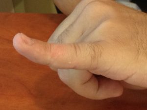 Σφυροδακτυλία (Mallet Finger)