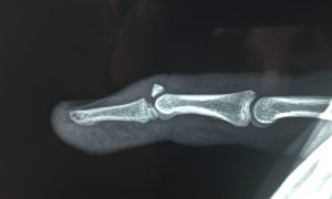 Σφυροδακτυλία (Mallet Finger)