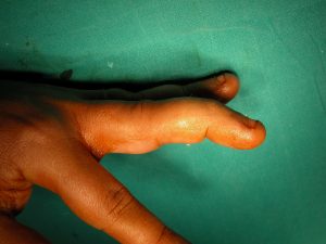 Παραμόρφωση Δίκην Λαιμού Κύκνου (Swan Neck Deformity)