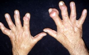 Αρθρίτιδες στο Χέρι