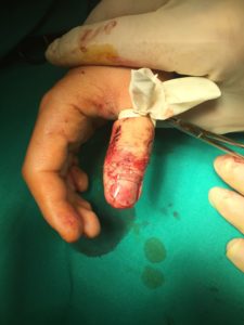 Τραυματισμοί Ακροδακτύλων (Tip injuries)