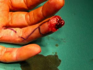 Τραυματισμοί Ακροδακτύλων (Tip injuries)
