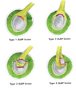 Τραυματισμοί της Εκφύσεως της Μακράς Κεφαλής του Δικεφάλου - SLAP Lesion